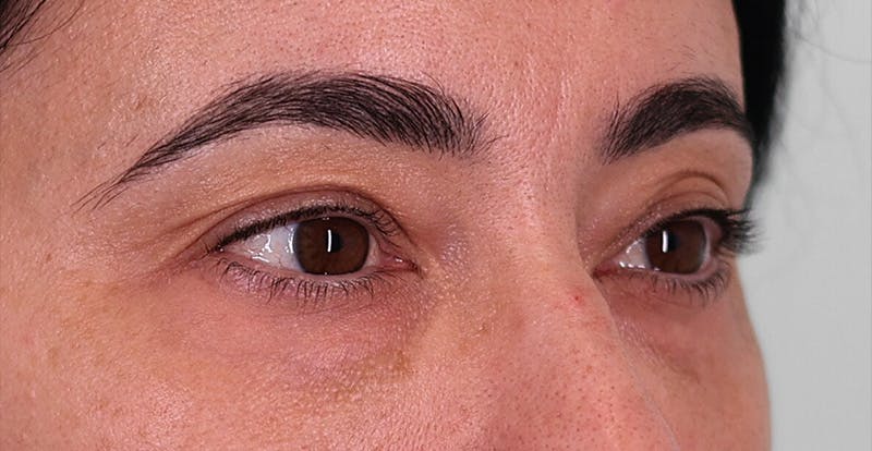 Upper Blepharoplasty Before & After Gallery - Patient 352796 - Image 3