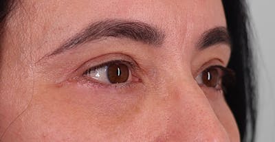 Upper Blepharoplasty Before & After Gallery - Patient 352796 - Image 2