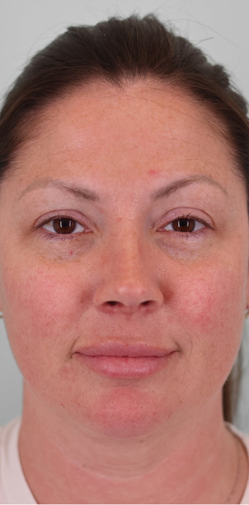 Rhinoplasty Before & After Gallery - Patient 332097 - Image 6