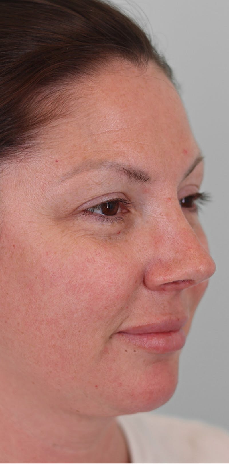 Rhinoplasty Before & After Gallery - Patient 332097 - Image 4
