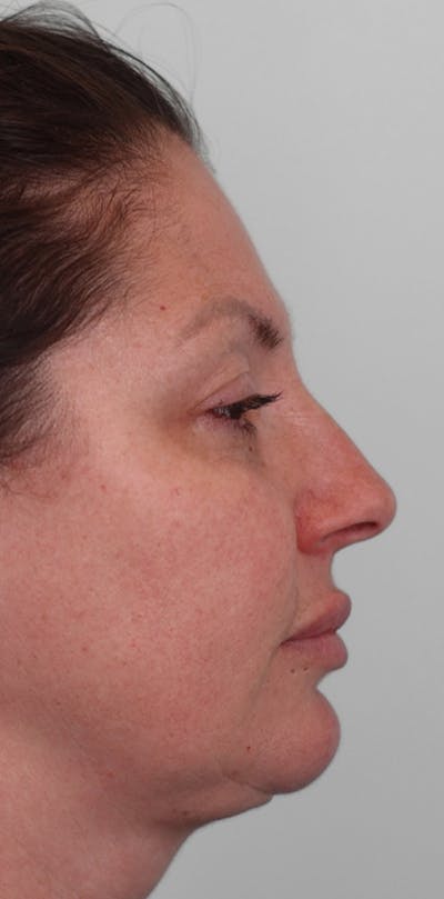 Rhinoplasty Before & After Gallery - Patient 332097 - Image 1