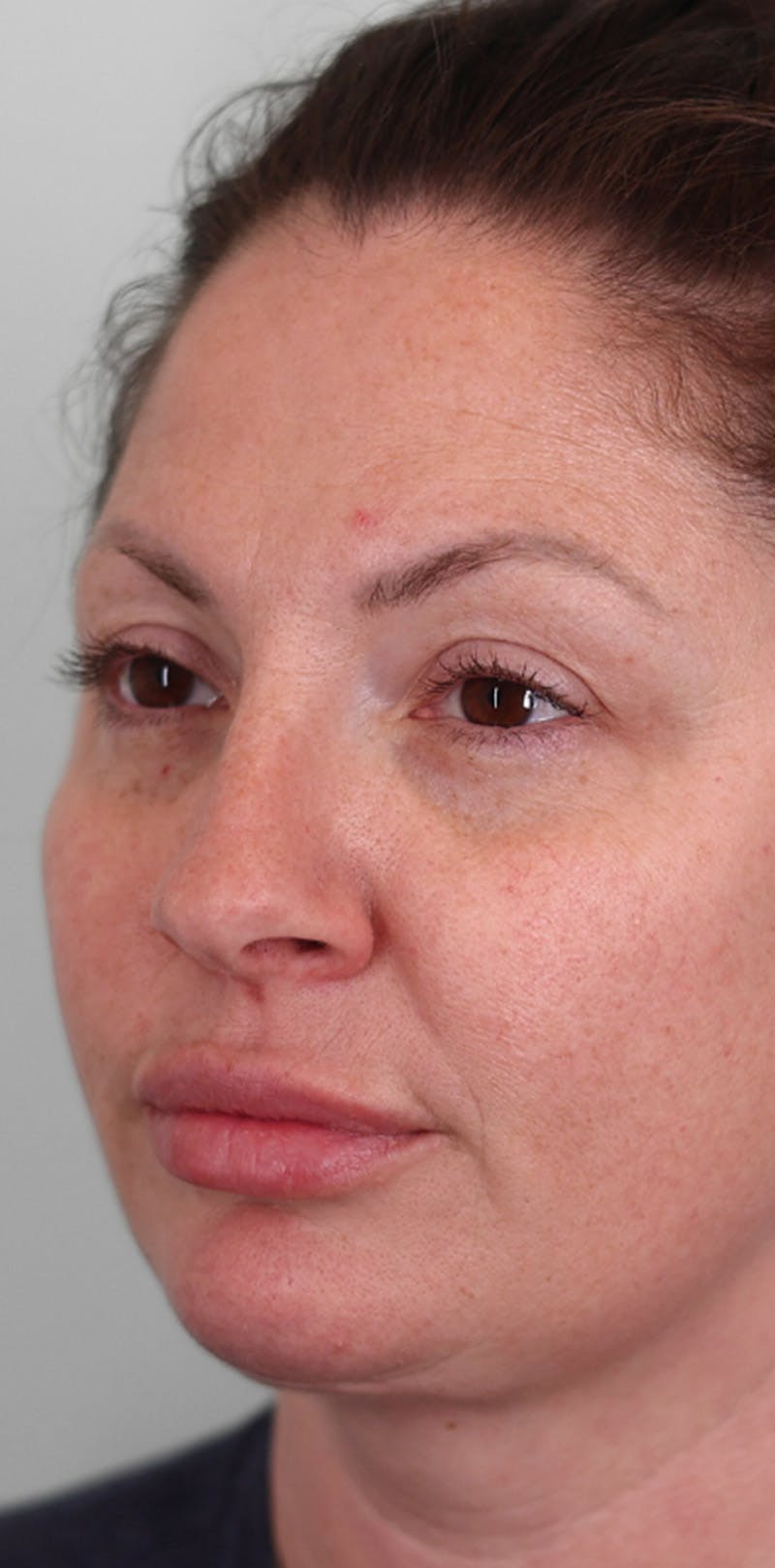 Rhinoplasty Before & After Gallery - Patient 332097 - Image 7