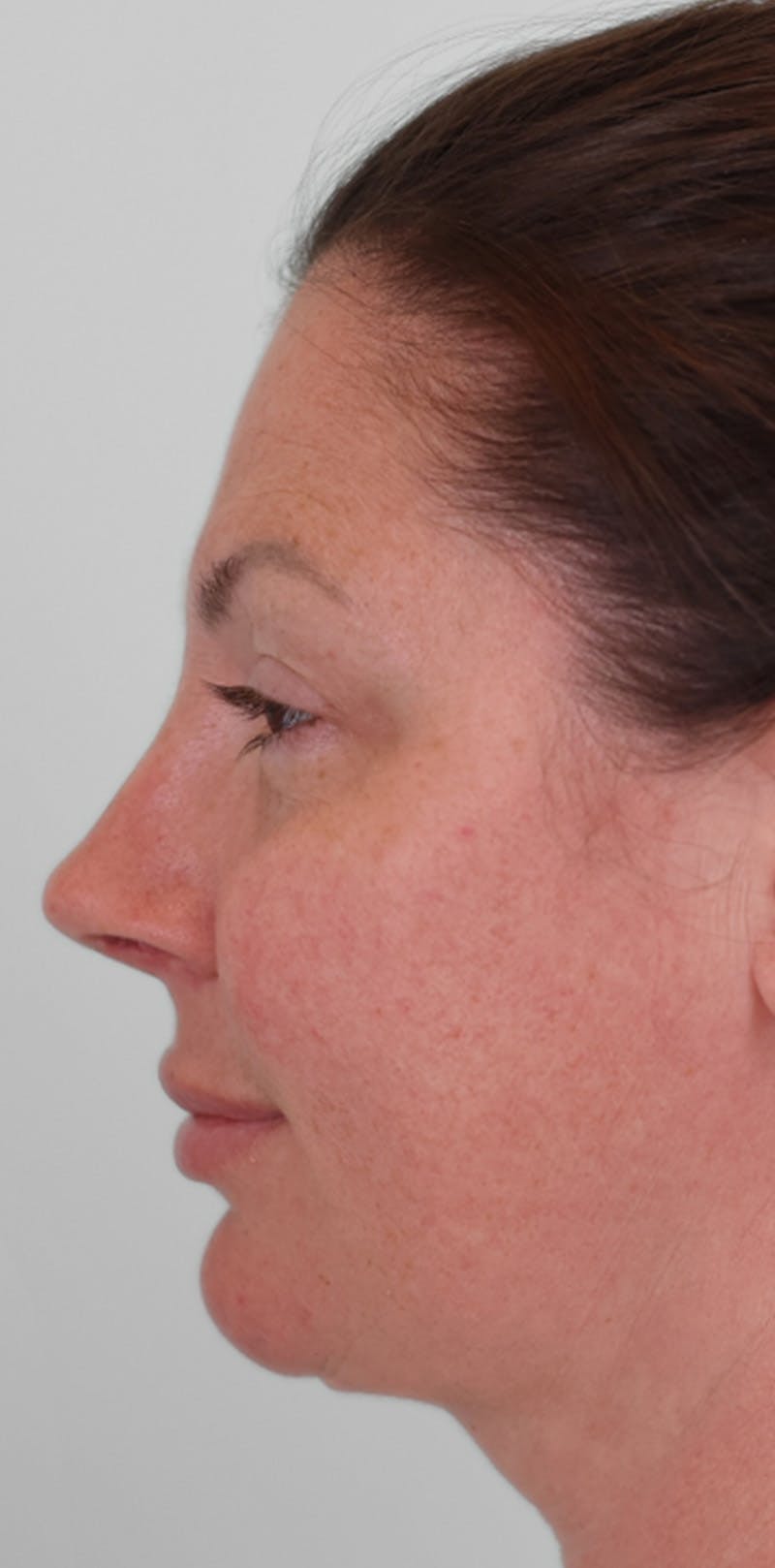 Rhinoplasty Before & After Gallery - Patient 332097 - Image 10