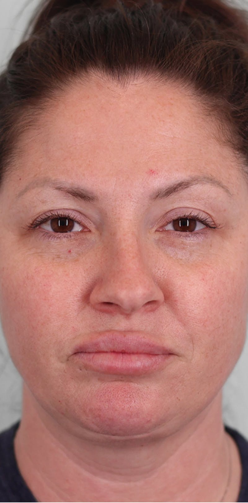 Rhinoplasty Before & After Gallery - Patient 332097 - Image 5