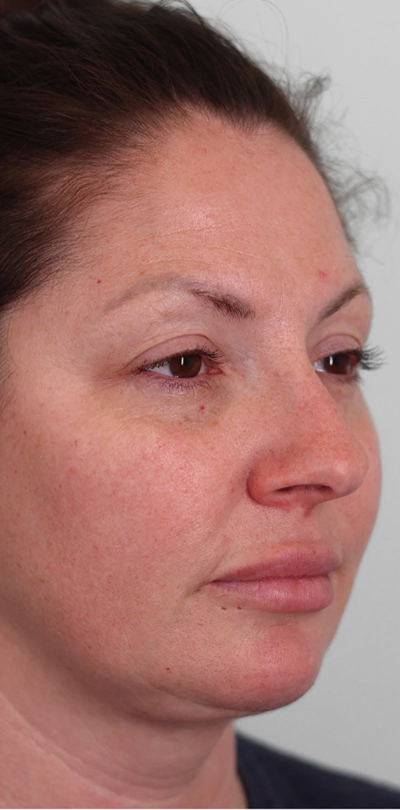 Rhinoplasty Before & After Gallery - Patient 332097 - Image 3