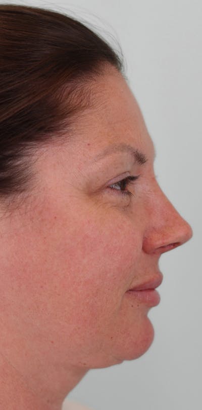 Rhinoplasty Before & After Gallery - Patient 332097 - Image 2