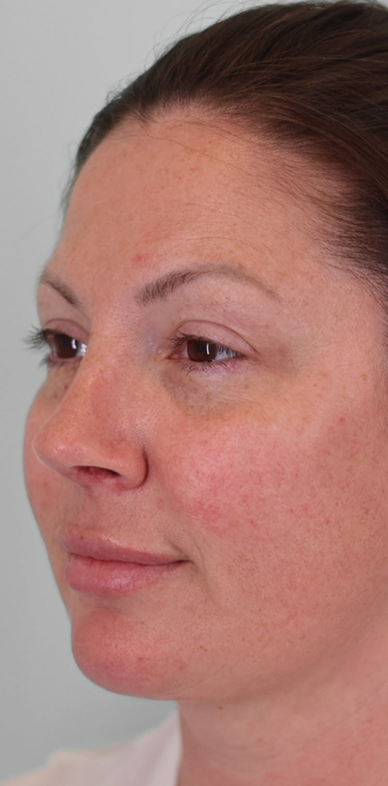 Rhinoplasty Before & After Gallery - Patient 332097 - Image 8