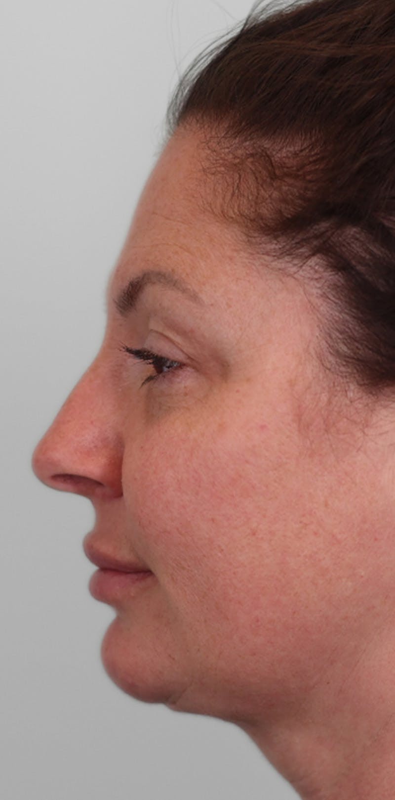 Rhinoplasty Before & After Gallery - Patient 332097 - Image 9