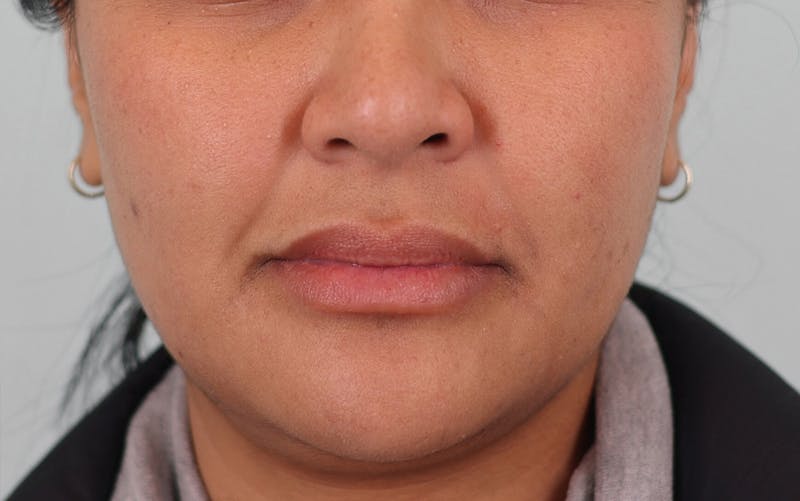Skin Treatments Before & After Gallery - Patient 339978 - Image 2
