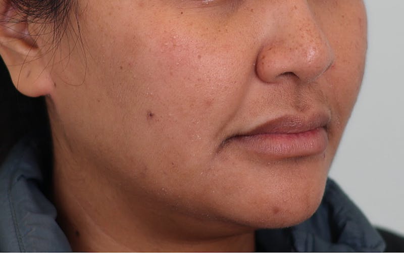 Skin Treatments Before & After Gallery - Patient 339978 - Image 3
