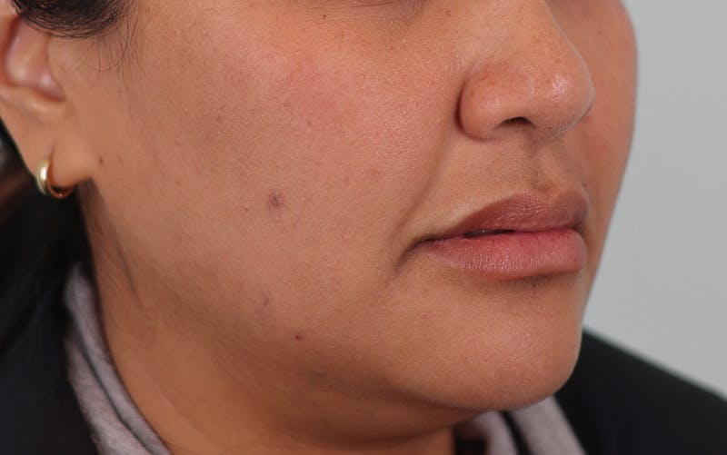 Skin Treatments Before & After Gallery - Patient 339978 - Image 4