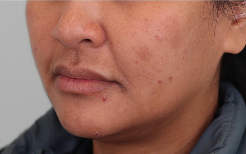 Skin Treatments Before & After Gallery - Patient 339978 - Image 5
