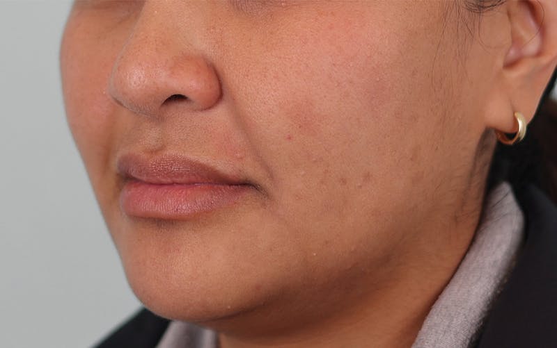 Skin Treatments Before & After Gallery - Patient 339978 - Image 6