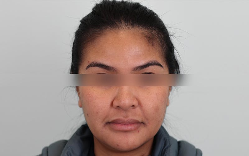 Skin Treatments Before & After Gallery - Patient 339978 - Image 7