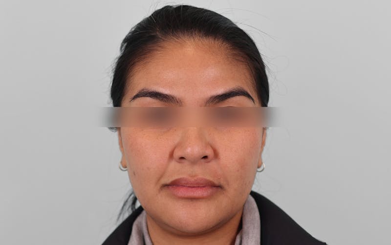 Skin Treatments Before & After Gallery - Patient 339978 - Image 8