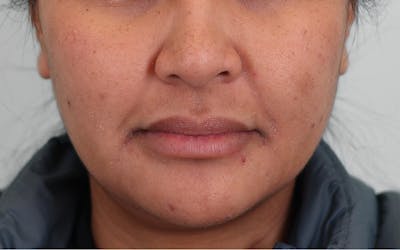 Skin Treatments Before & After Gallery - Patient 339978 - Image 1