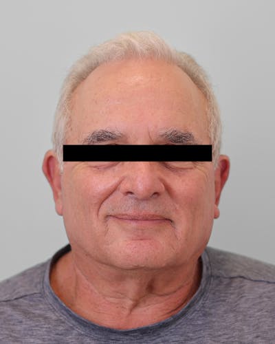 Skin Treatments Before & After Gallery - Patient 137383 - Image 2