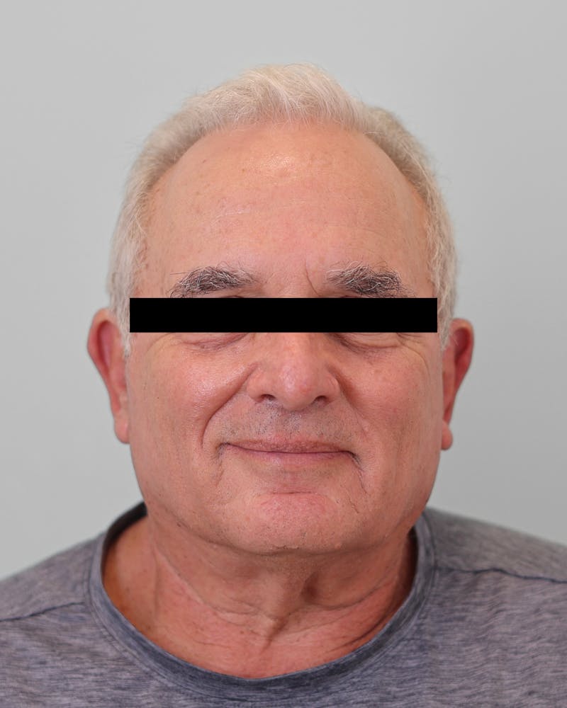 Skin Treatments Before & After Gallery - Patient 137383 - Image 2
