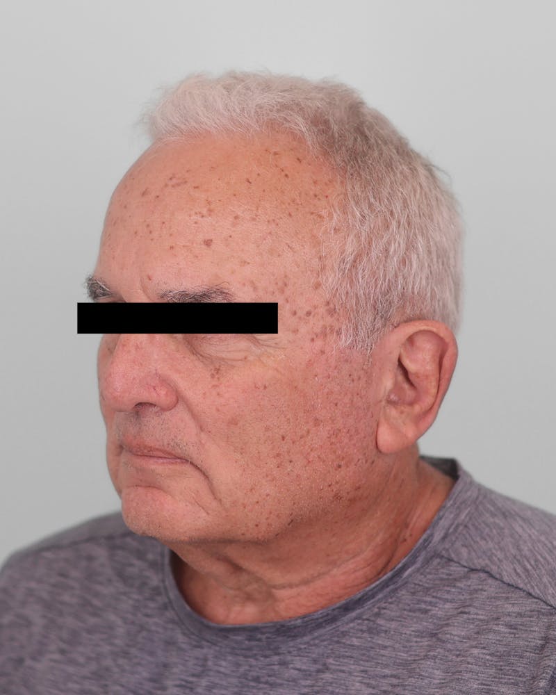 Skin Treatments Before & After Gallery - Patient 137383 - Image 3