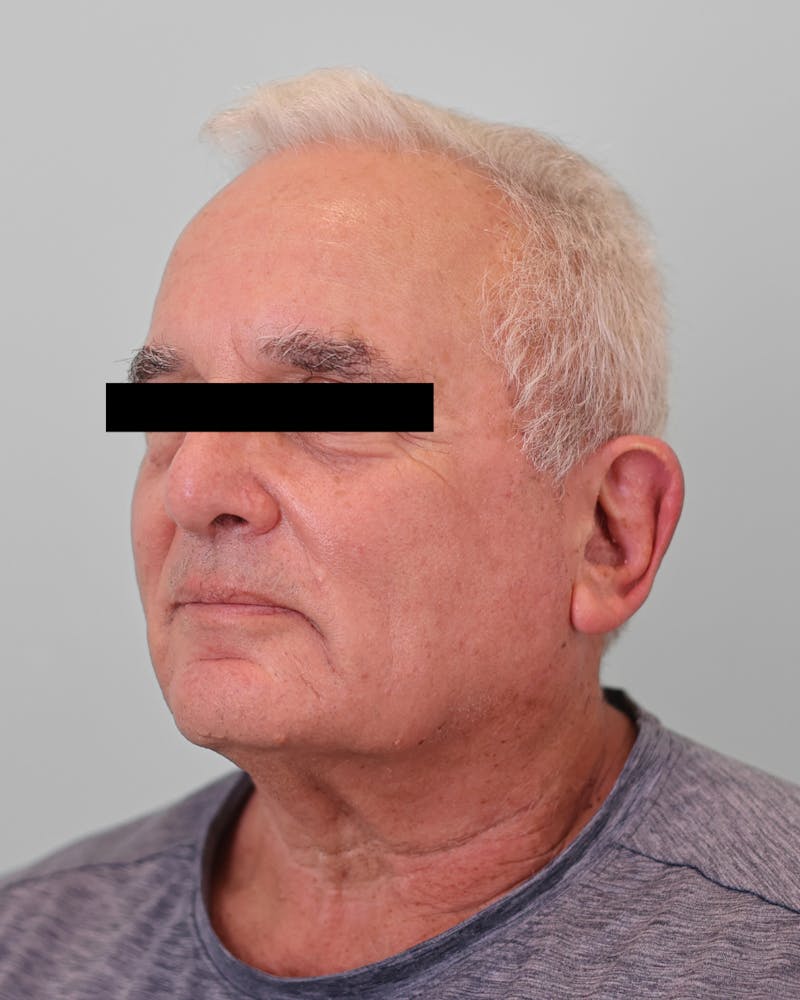 Skin Treatments Before & After Gallery - Patient 137383 - Image 4