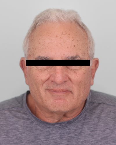 Skin Treatments Before & After Gallery - Patient 137383 - Image 1