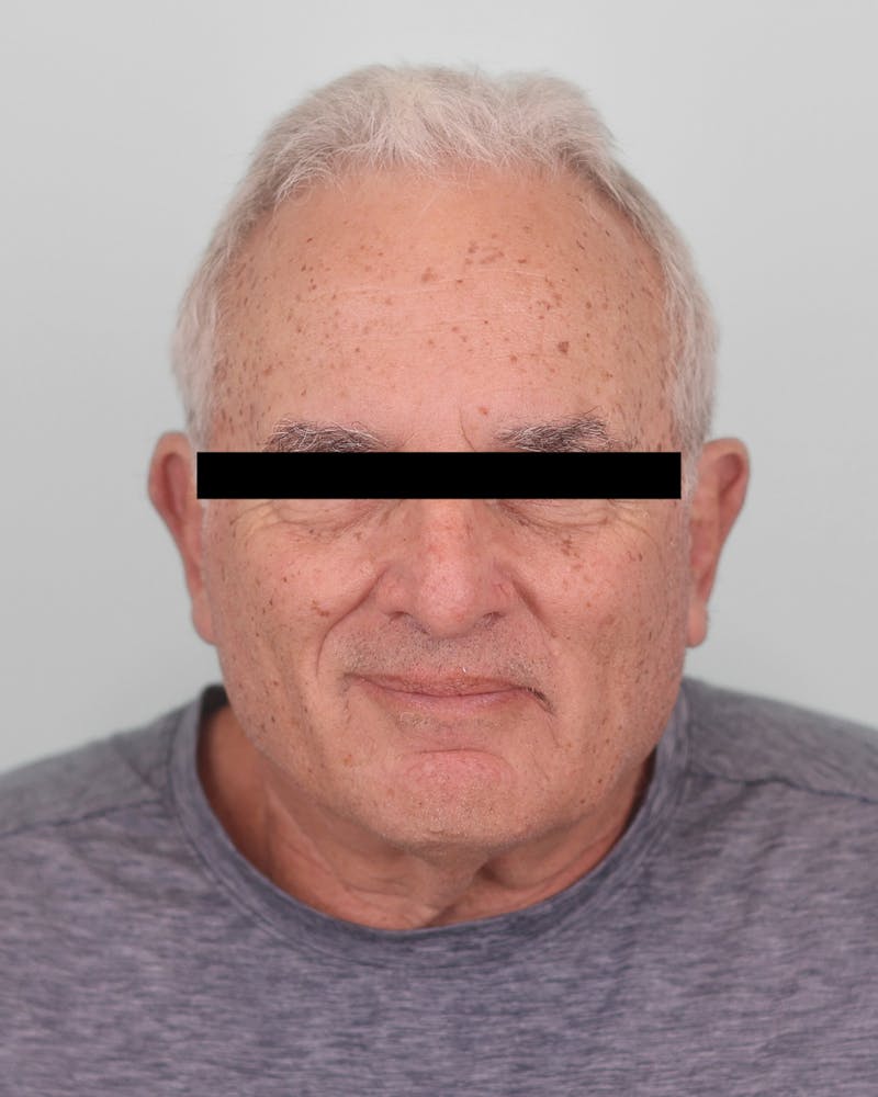 Skin Treatments Before & After Gallery - Patient 137383 - Image 1