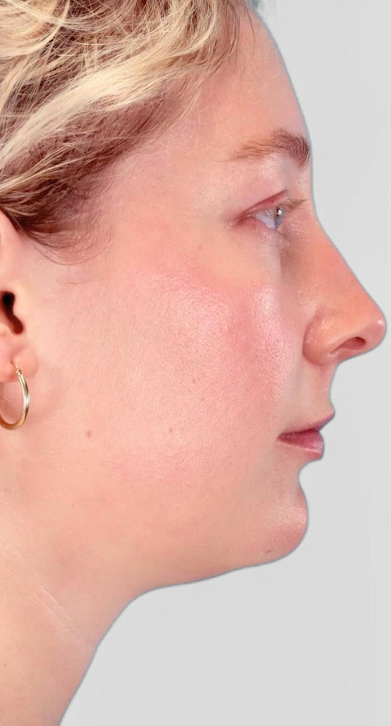 Neck Liposuction Before & After Gallery - Patient 111968 - Image 1