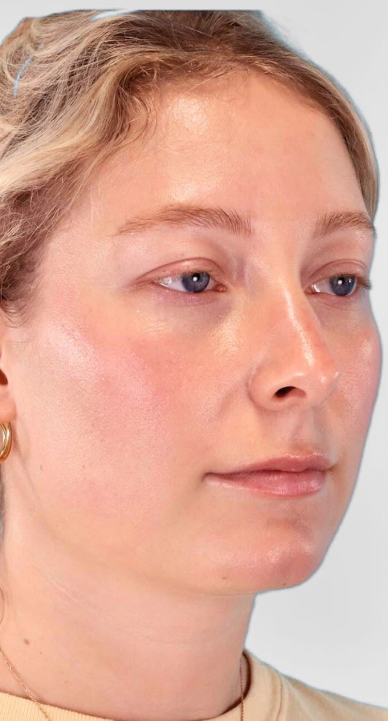 Neck Liposuction Before & After Gallery - Patient 111968 - Image 3