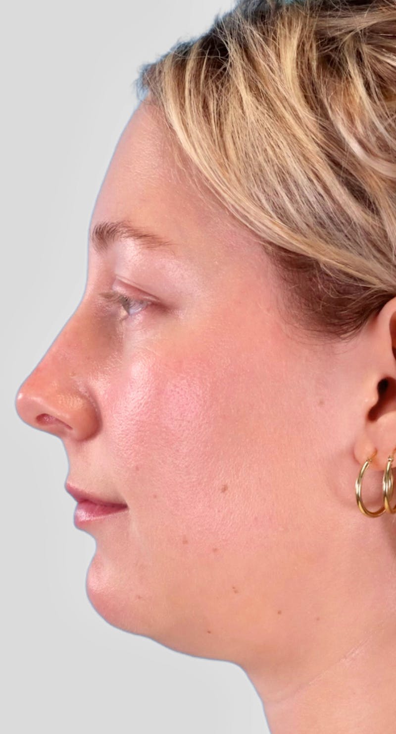Neck Liposuction Before & After Gallery - Patient 111968 - Image 5