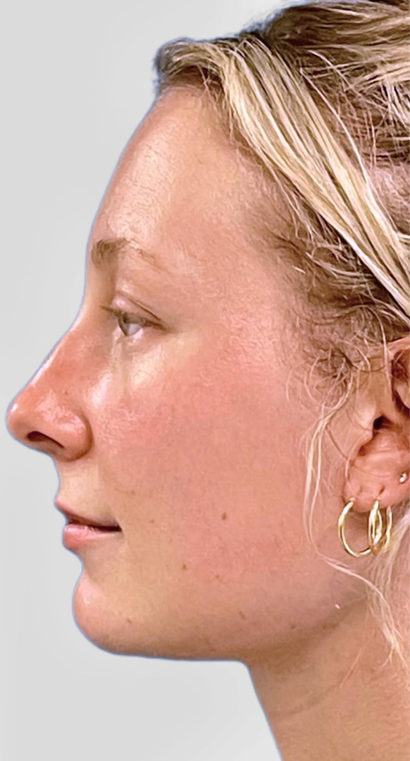 Neck Liposuction Before & After Gallery - Patient 111968 - Image 6
