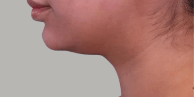 Neck Liposuction Before & After Gallery - Patient 380256 - Image 1