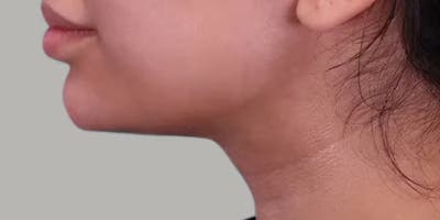 Neck Liposuction Before & After Gallery - Patient 380256 - Image 2