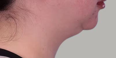 Neck Liposuction Before & After Gallery - Patient 331260 - Image 1