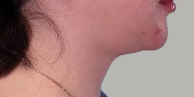 Neck Liposuction Before & After Gallery - Patient 331260 - Image 2