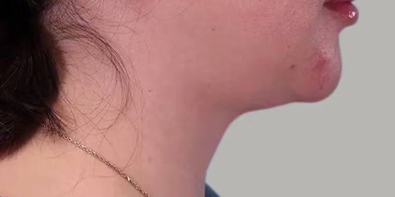 Neck Liposuction Before & After Gallery - Patient 331260 - Image 2
