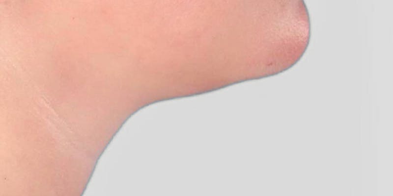 Neck Liposuction Before & After Gallery - Patient 111968 - Image 3
