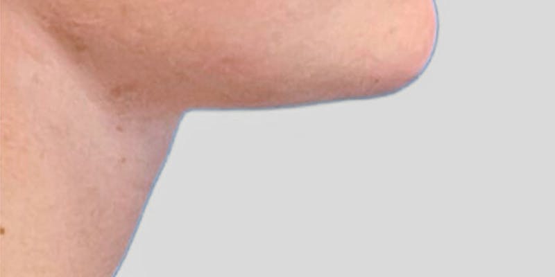 Neck Liposuction Before & After Gallery - Patient 111968 - Image 4