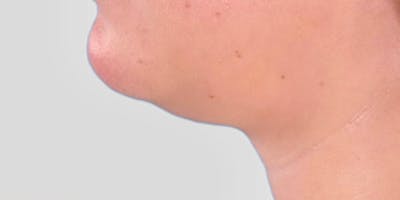 Neck Liposuction Before & After Gallery - Patient 111968 - Image 1