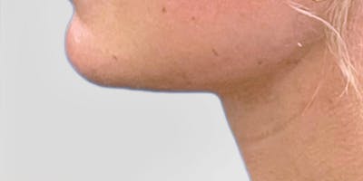 Neck Liposuction Before & After Gallery - Patient 111968 - Image 2