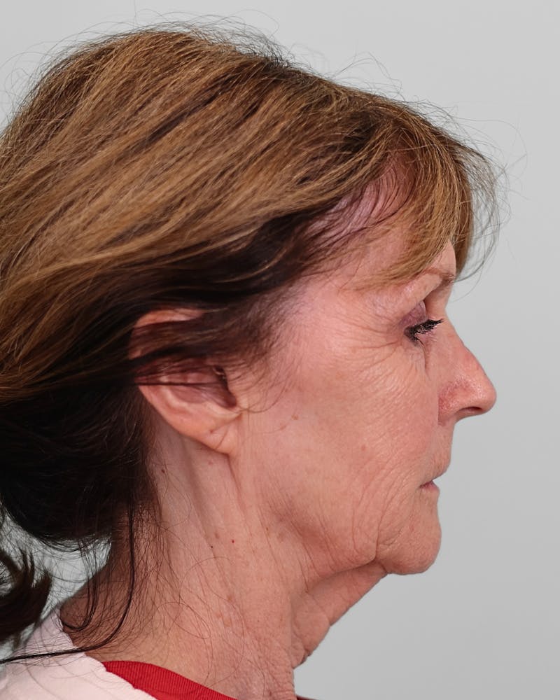 Facelift Before & After Gallery - Patient 268516 - Image 9
