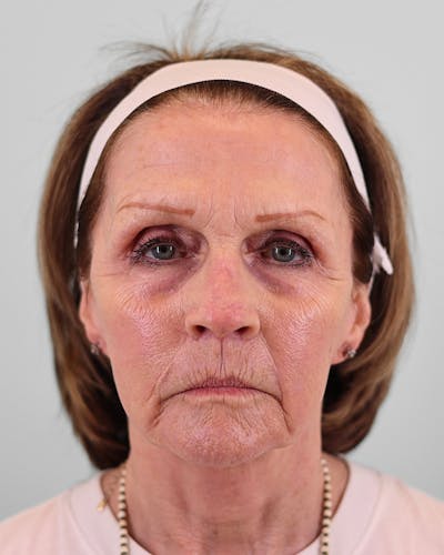 Neck Lift Before & After Gallery - Patient 206893 - Image 2