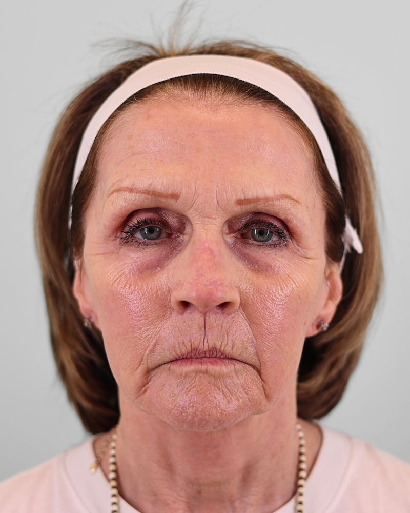 Facelift Before & After Gallery - Patient 268516 - Image 2