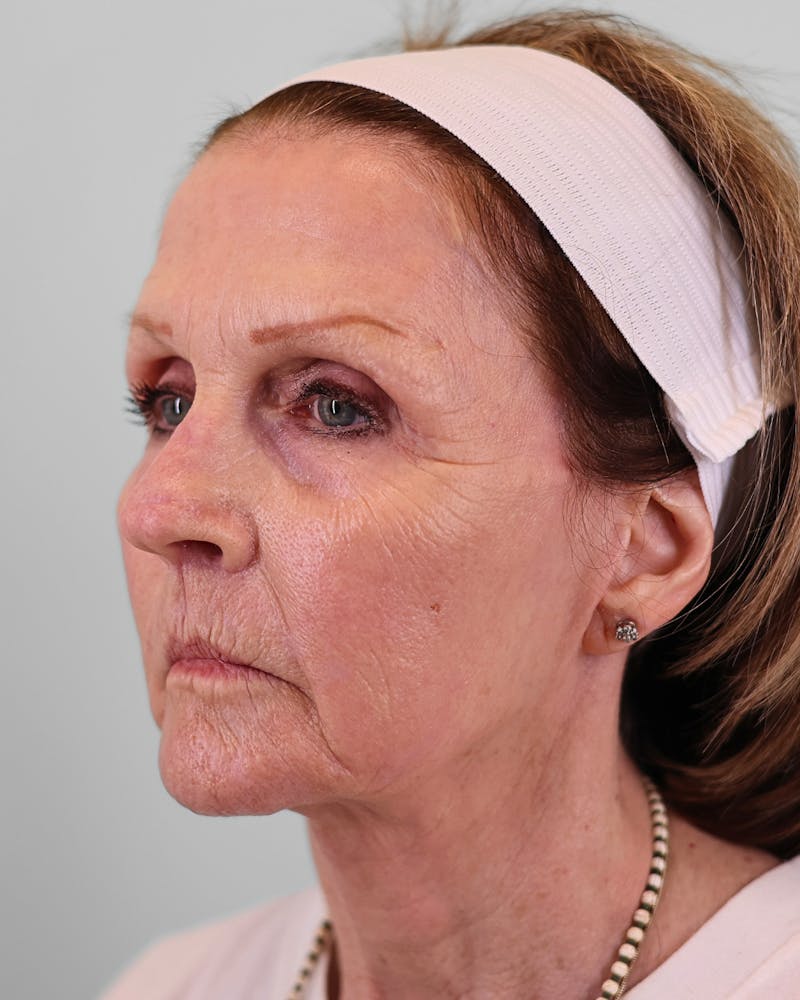 Facelift Before & After Gallery - Patient 268516 - Image 6
