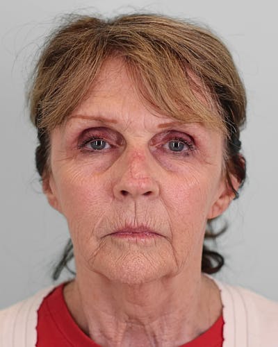 Neck Lift Before & After Gallery - Patient 206893 - Image 1