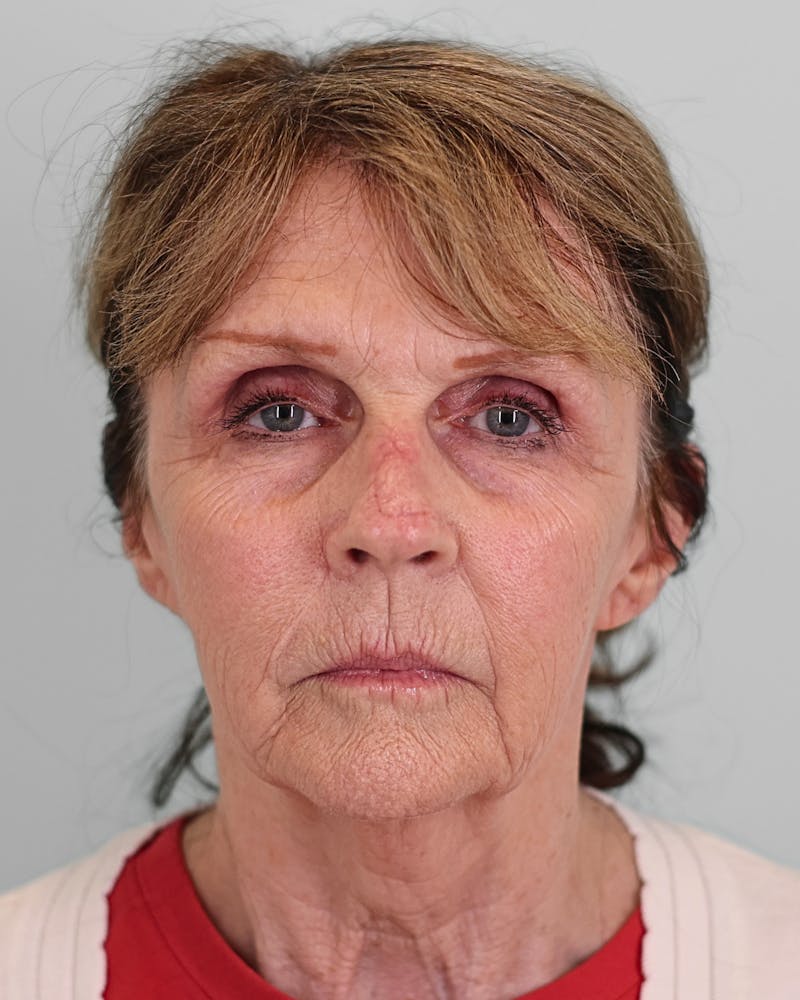 Facelift Before & After Gallery - Patient 268516 - Image 1