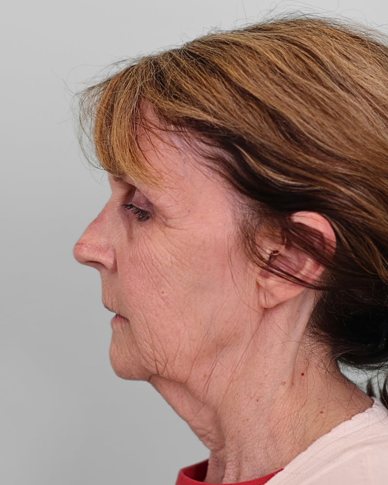 Facelift Before & After Gallery - Patient 268516 - Image 3