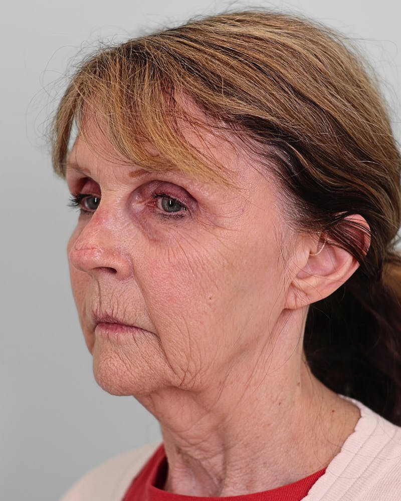 Facelift Before & After Gallery - Patient 268516 - Image 5