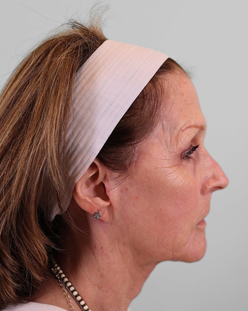 Facelift Before & After Gallery - Patient 268516 - Image 10