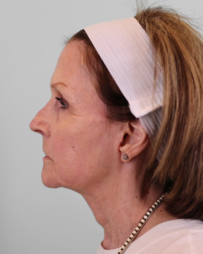 Facelift Before & After Gallery - Patient 268516 - Image 4