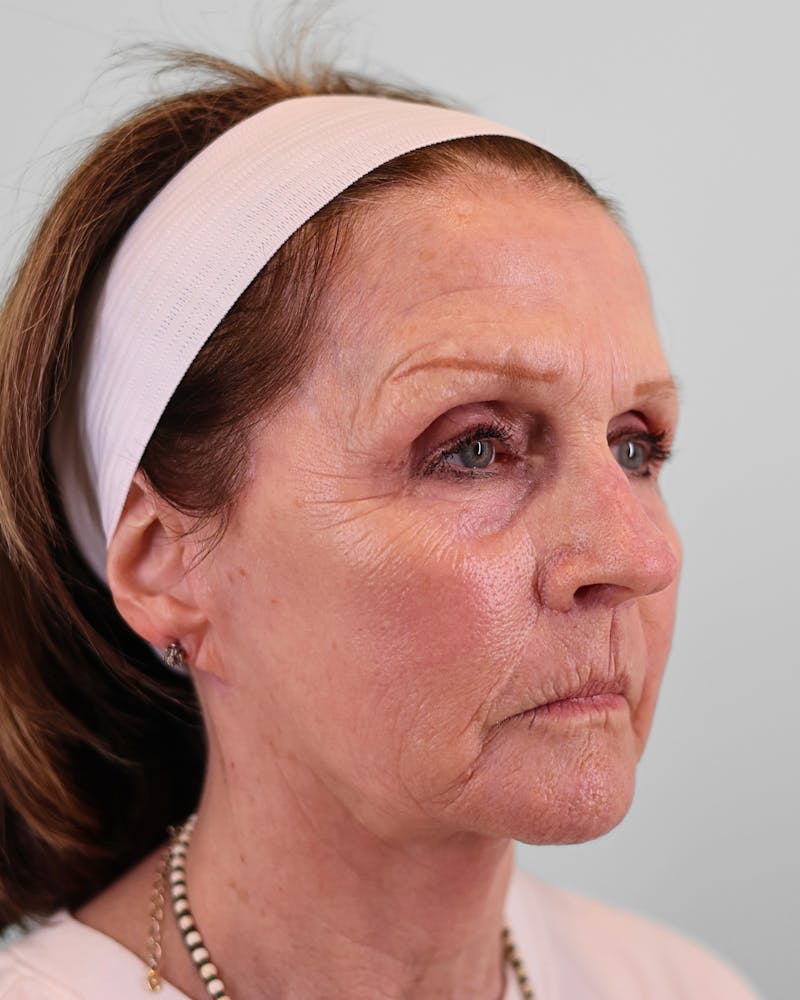 Facelift Before & After Gallery - Patient 268516 - Image 8